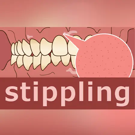 健康な歯茎を表すスティップリングとは？